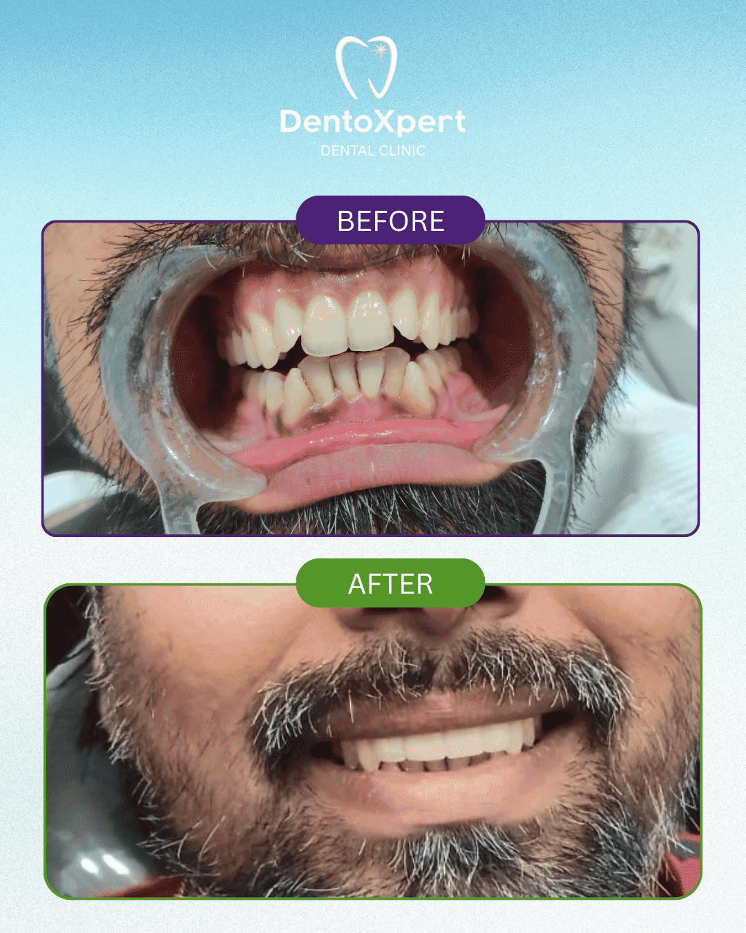 Before and after dental treatment result at DentoXpert Dental Clinic in Thane